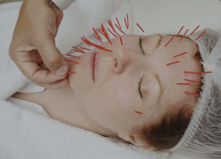 Moje veto i słów kilka nt. akupunktury kosmetycznej