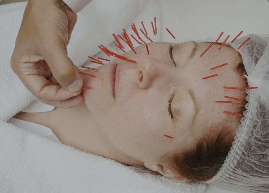 Moje veto i słów kilka nt. akupunktury kosmetycznej